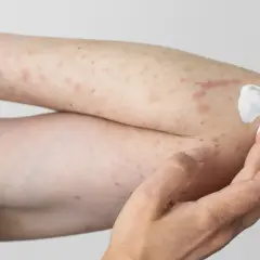 Arm mit roten Flecken und Creme, deutet auf einen **pollenallergie ausschlag** hin.