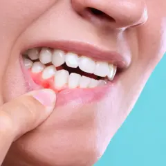 Dito un dito indica gengive rosse e gonfie, segno di gengivite. La cura è fondamentale per la salute orale.