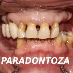 Zaawansowana paradontoza, widoczne ubytki kości i odsłonięte korzenie zębów. Konieczne pilne leczenie.