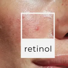 Zbliżenie na skórę z niedoskonałościami, w tym pryszczami i bliznami potrądzikowymi. W ramce napis "retinol", sugerujący pytanie: retinol od jakiego wieku można stosować.