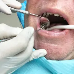 Dentysta usuwa korzeń zęba z ropą. Widać narzędzia stomatologiczne i usta pacjenta.