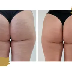 Endermologia: Jak często dla najlepszych efektów? Pełny plan