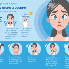 Illustration sur l'acné des adolescents. Cinq étapes pour gérer les boutons de puberté : ne pas toucher, laver, démaquiller, hygiène de vie, consulter un dermatologue.