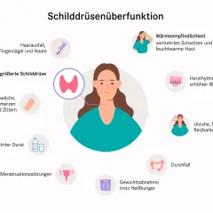 Schilddrüsenüberfunktion: Haarausfall, Herzrasen, Gewichtsverlust trotz Heißhunger. Zu viel Jod kann Symptome wie diese verursachen.