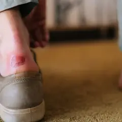 Zdarta skóra do mięsa na pięcie, jak leczyć otarcie po nowym obuwiu.
