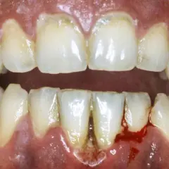 Gengive infiammate e sanguinanti, denti ingialliti e con tartaro, un quadro di dolore alle gengive e denti che necessita cure.