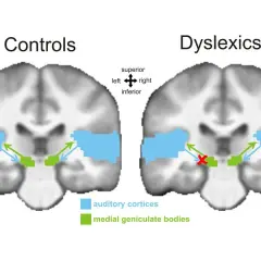 Czy dysleksja to choroba? Prawda o zaburzeniu neurorozwojowym