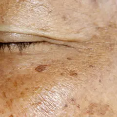 Hautnah: Pigmentflecken im Detail. Vorher-Nachher-Vergleich mit Zitrone zur Aufhellung.