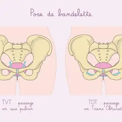 Schéma comparant deux techniques de pose de bandelette pour l'incontinence à l'effort : TVT (passage sus-pubien) et TOT (passage transobturateur).