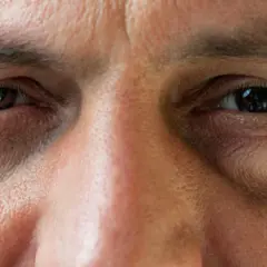 Nahaufnahme eines Gesichts mit einem leicht geschwollenen Auge. Was tun bei einem Auge angeschwollen? Hier sind Tipps.