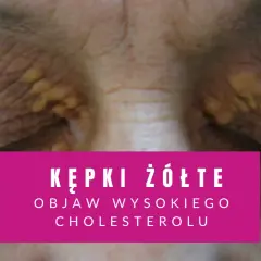 Żółte kępki na powiekach, widoczne na zbliżeniu.