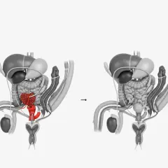 Anatomische Darstellung: Vorher (Prostata rot hervorgehoben) und nach der Prostataentfernung.
