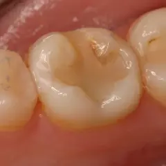 Detalle de un empaste mal hecho en un diente, con irregularidades y zonas de coloración amarillenta.