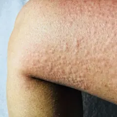 Pelle arrossata con piccoli pomfi, tipica dell'orticaria. Scopri come curarla.