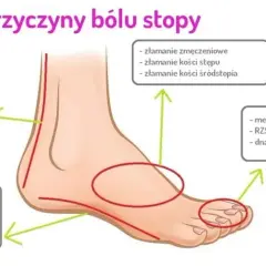 Ból stopy: Kiedy to alarm? Poznaj przyczyny i objawy