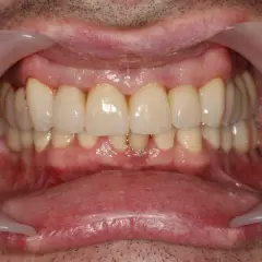 Uśmiech po leczeniu. Zdrowe dziąsła i zęby, to cel periodontologii. Co to jest? To dziedzina stomatologii zajmująca się leczeniem chorób przyzębia.