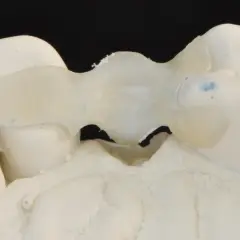 Modello di protesi dentale, un ponte Maryland, che sostituisce denti mancanti.