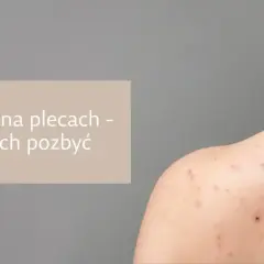 Ropny pryszcz: Szybkie i bezpieczne metody bez blizn!
