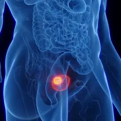 Anatomical illustration showing a tumor within the bladder, symbolizing the progression of umieranie na raka pęcherza.