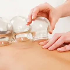 Coppette di vetro applicate sulla schiena, una tecnica che, come l'agopuntura, mira al benessere.