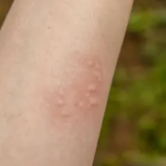 Na skórze ramienia widoczne są czerwone, wypukłe bąble, objaw pokrzywki alergicznej.