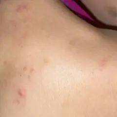 Piel con marcas rojas y elevadas, indicando posible acne en la espalda.