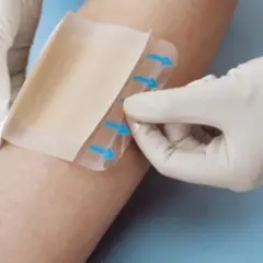 Ręce w rękawiczkach zakładają nowoczesne opatrunki na rany na skórę, zapewniając ochronę i komfort.