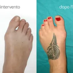 Confronto alluce valgo prima e dopo intervento. Il piede sinistro mostra un evidente alluce valgo, il destro è corretto.