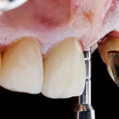 Dettaglio di un impianto dentale provvisorio in fase di posizionamento, con strumenti dentistici e denti in primo piano.