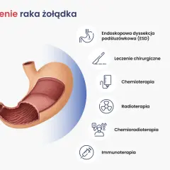 Nowoczesne leczenie raka żołądka obejmuje ESD, chirurgię, chemioterapię, radioterapię, chemioradioterapię i immunoterapię.