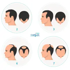 Escala de Norwood que muestra la progresión de la pérdida de cabello, desde una densidad capilar completa hasta la calvicie.