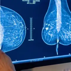 Vorsorge Brustkrebs ab wann: Wichtige Informationen zur Früherkennung