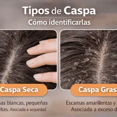 Dos tipos de caspa: seca (escamas blancas, sueltas) y grasa (amarillentas, adheridas). Aprende cómo quitar la caspa identificando la tuya.