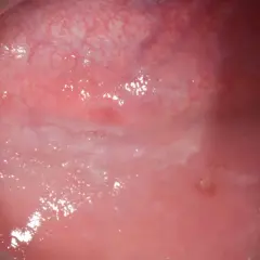 Guancia interna con lesione biancastra, possibile esito di un morso. Rimedi naturali per favorire la guarigione.