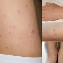 Skóra z licznymi czerwonymi, swędzącymi zmianami, które mogą być objawem ugryzienia roztoczy. Widoczne na brzuchu, ręce, nodze i stopach.