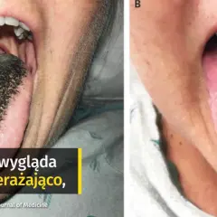 Bolesne afty w jamie ustnej? Odkryj przyczyny i szybką ulgę!
