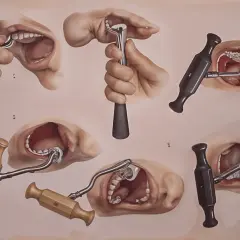 Zębodół. Różne narzędzia dentystyczne w akcji, pokazujące ich zastosowanie w jamie ustnej.