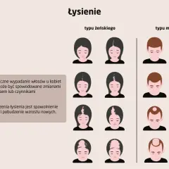 Ilustracja pokazuje różne rodzaje łysienia u kobiet i mężczyzn, od początkowych etapów po zaawansowane.
