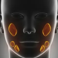 Anatomia ślinianek z widocznymi ogniskami kamicy. Złote plamy symbolizują kamienie w śliniankach.