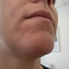 Närbild på en persons haka och mun. Huden runt munnen är röd och irriterad, vilket kan vara tecken på perioral dermatit, ibland kopplat till klimakteriet.