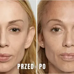 Przed i po zabiegu z użyciem kwasu polimlekowego. Skóra twarzy jest gładsza, bardziej napięta i odmłodzona.