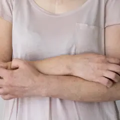 Dłonie i ramiona kobiety z widocznymi zmianami skórnymi, sugerującymi nerwicę skóry.