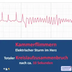 EKG-Kurve zeigt Kammerflimmern, einen elektrischen Sturm im Herz, der zu totalem Kreislaufzusammenbruch führt. Defibrillation ist hier lebensrettend.