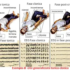 Illustrazione delle fasi di una crisi epilettica tonico-clonica: rigidità, cianosi, incontinenza, bava, clonie, incoscienza. Sintomi premonitori e EEG.