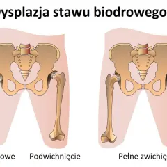 Ilustracja porównuje zdrowe biodro z dysplazją stawu biodrowego u dorosłych, pokazując podwichnięcie i pełne zwichnięcie.