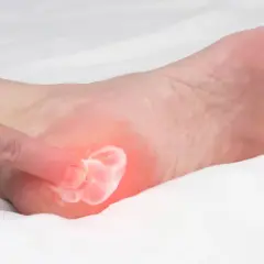 Application d'une crème pour soulager la douleur d'une aponévrosite plantaire. Un doigt masse la zone rouge sur le talon.
