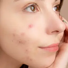 Nahaufnahme eines Gesichts mit Akne. Die Hautbarriere scheint gereizt zu sein, mit roten Flecken und Pickeln.