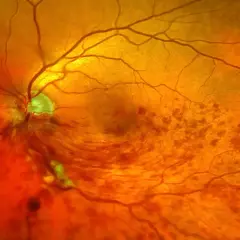 Nahaufnahme des Augenhintergrunds mit Anzeichen eines Schlaganfalls im Auge. Blutgefäße sind sichtbar, einige Bereiche sind verfärbt.