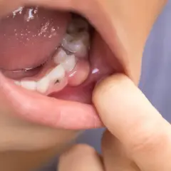 Boca con diente cariado y encía inflamada. Podría ser necesario un tratamiento de pulpotomía que es.