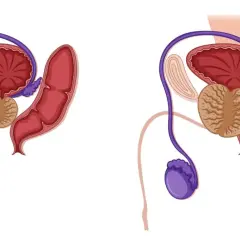 Schéma comparatif du système urinaire masculin. La prostate agrandie peut causer une fuite urinaire après grattage.